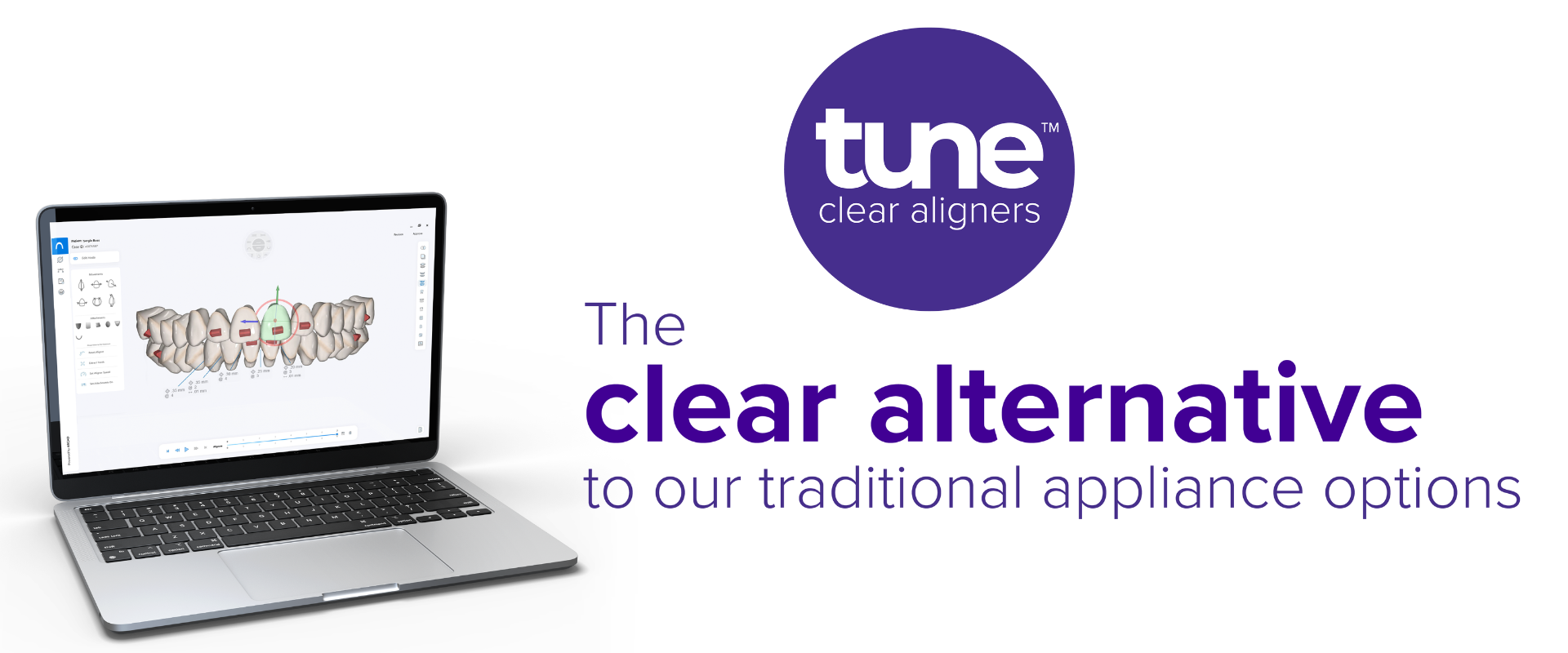 Tune clear aligners